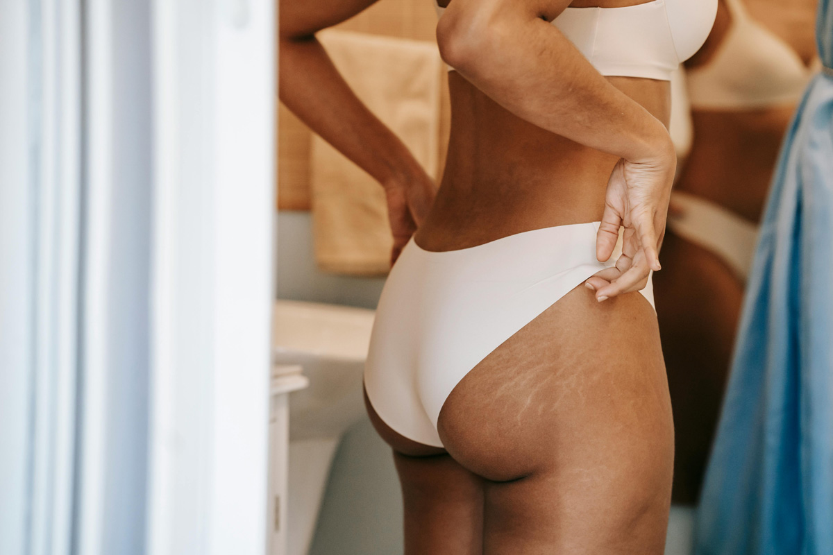 растяжки на коже