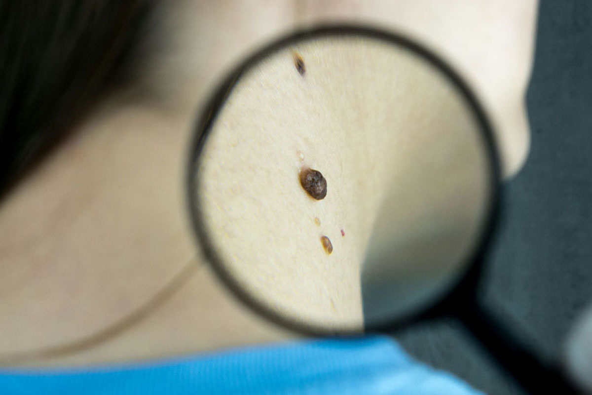 опасные родинки